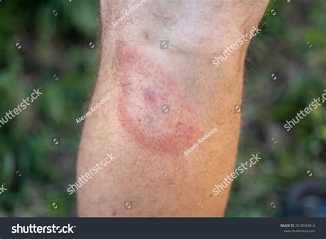 tick bite images stock   objects vectors shutterstock