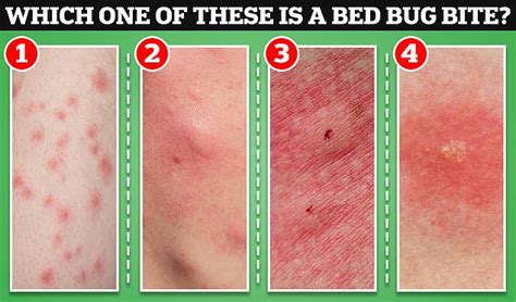 Flea Bites Vs Bed Bug Bites On Humans