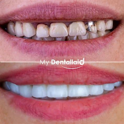 Tooth Crown Before and After - Reviews - Dentallaid