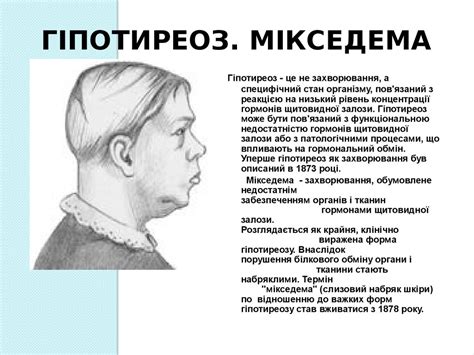 Щитоподібна залоза. Гіпертеріоз - презентация онлайн