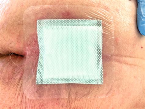 Fallbeispiel: Druckentlastung und Wundbehandlung bei Dekubitus - DocCheck