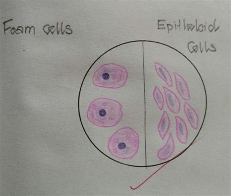 Histopathology Drawings: Foam cells and Epithelioid cells( note the spelling- its ..lioid)