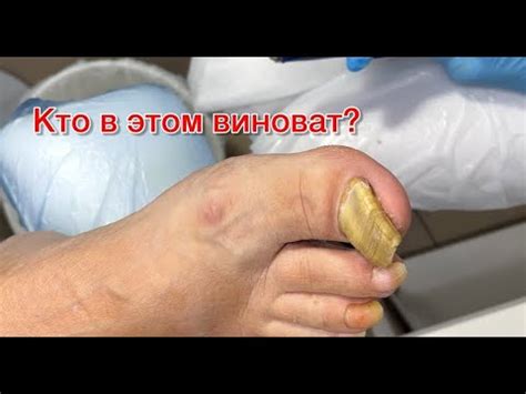 ТОЛСТЫЙ НОГОТЬ РАСТЕТ В БОК. КАК СРЕЗАТЬ ТОЛСТЫЕ НОГТИ. ЖЕЛТЫЙ НОГОТЬ ...