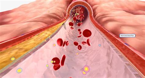 premium photo cardiovascular disease  commonly caused