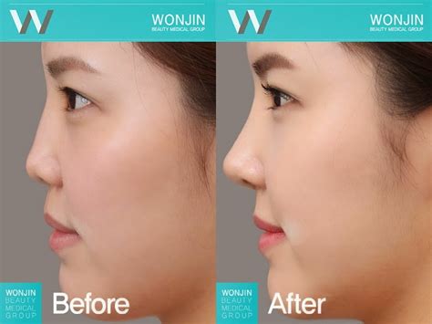 Lihat lebih dalam mengenai bentuk hidung yang ideal!