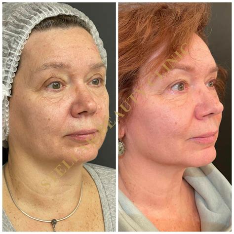 Микроигольчатый RF-лифтинг DeAge-EX DUAL - STELLAR BEAUTY CLINIC