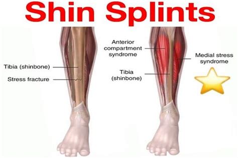 All You Need to Know About Shin Splints | The Footcare Clinic