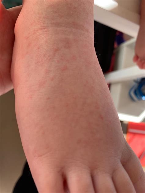 The facts on Hand Foot & Mouth Disease | CPR Kids