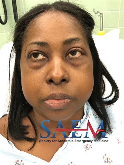 Hypothyroidism Face Swelling