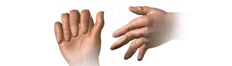Arthritis Natural Remedies