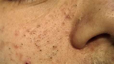 Unbelievable Blackhead Removal 2024: A Comprehensive Overview - ppi5f10
