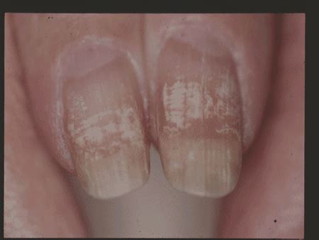 White Spots on Toenails: What To Know, white toenails