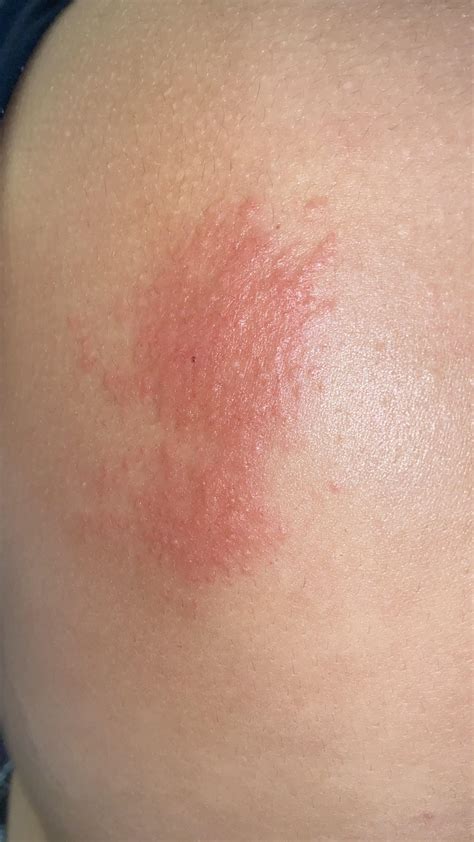 Are these bed bug bites? Low level of itching. : bugbites