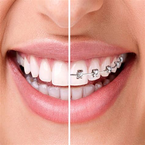 Установка брекетов - Smile Boutique