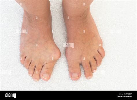 bunion  joint  big toe  feet comparison   bunion