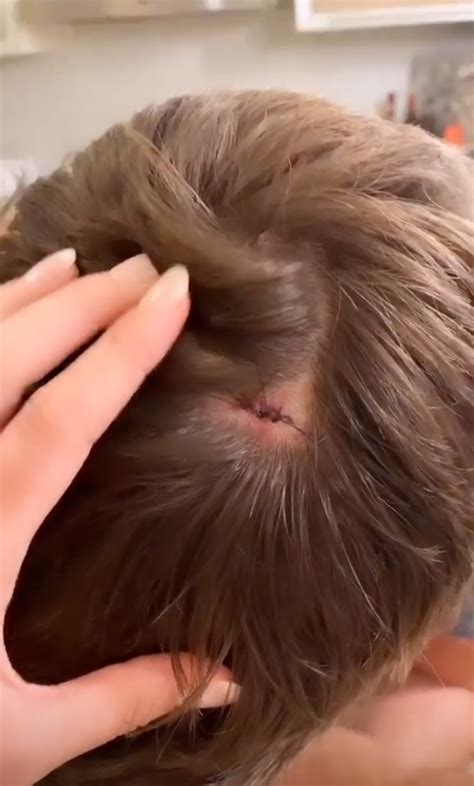 Jordan Rodgers Gets Stitches in His Head After Gruesome Workout Injury