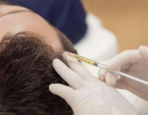PRP - کلینیک زیبایی دکتر کریم زاده