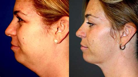 liposuction
