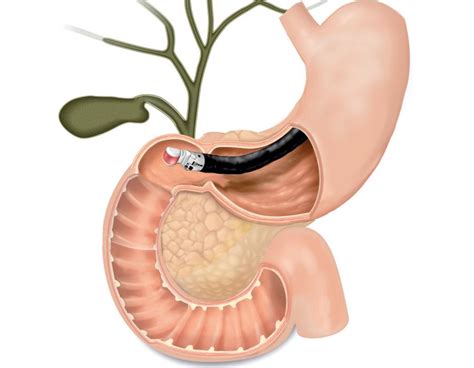 endoscopic ultrasound procedure  sg united gastro  endoscopy clinic