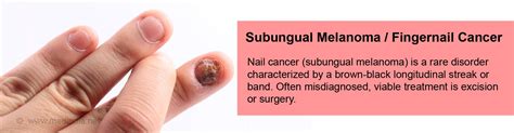Melanoma Under Nail Symptoms - Doctor Heck