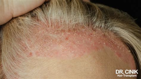 how to get rid of psoriasis in scalp