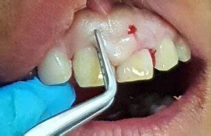 Gingival pocket exploration and marking on facial surface of 11 and 21 ...
