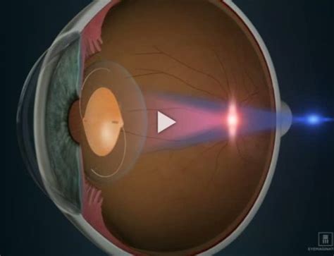 toric lens implant video fort lauderdale eye institiute
