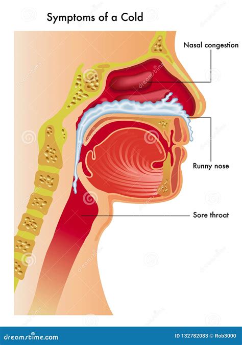 Symptoms of cold stock vector. Illustration of background - 132782083