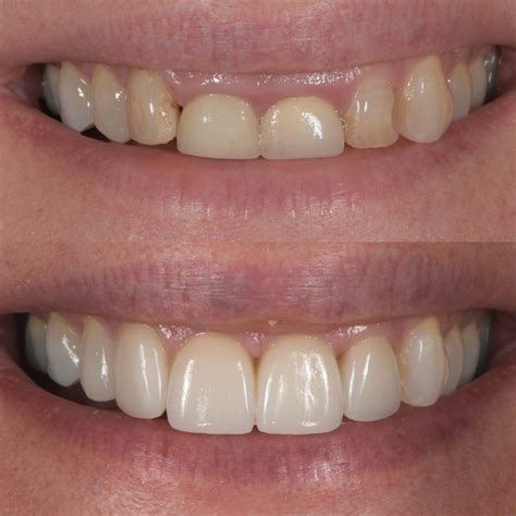 smile enhancement dawood  tanner