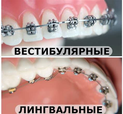 брекеты для исправления прикуса: виды и назначение