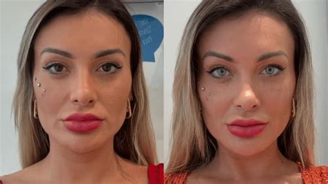 Vanessa Urach Antes E Depois - Urach faz cirurgia para mudar a cor dos olhos; veja antes e depois