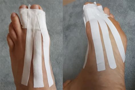 BJJ Turf Toe: How to Tape, Treat and Prevent BJJ Toe Injuries