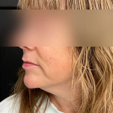 face filler medaesthetics
