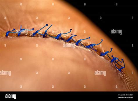 Surgical sutures. Close-up of sutures (stitches) in a patient's hand ...