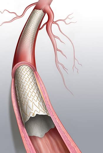 greater patency  covered stent  angioplasty   av fistulae