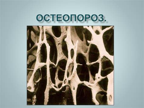 Остеопороз. Диагностика - презентация онлайн