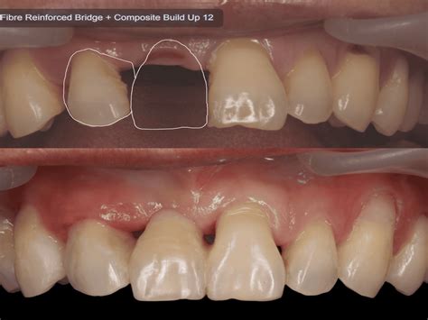 dental onlay crown bridge services  tooth restoration  puchong