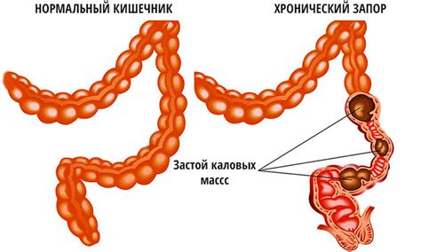 Массаж живота при запоре у взрослых для нормолизации кишечника