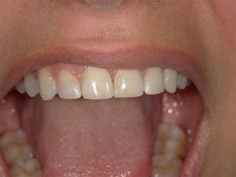 Esthetic Correction of Failed Color Match – McFarlane Dental