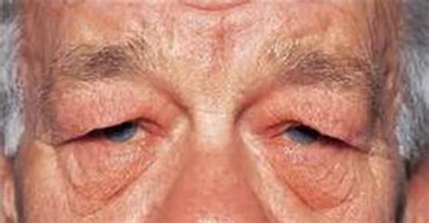 Dermatochalasis & Blepharoplasty | South Texas Eye Institute