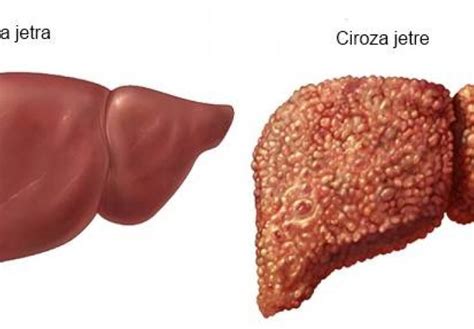 Ciroza jetre - Novi.ba