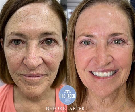 Laser Skin Rejuvenation Before and After Pictures Client #150 | Tampa
