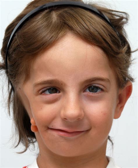 Sindrome De Goldenhar Fotos - RETOEDU