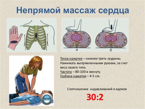 Непрямой массаж сердца - техника выполнения, особенности