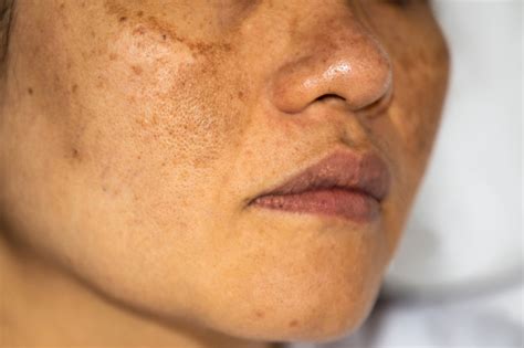 Skin Pigmentation Treatment in Ilford | Shumaila's