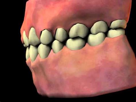 Hyperplasia Gingival: sabab, Gejala, sareng Perawatan - Kasehatan - 2023