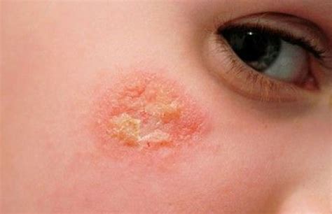 Экзема - причины и лечение | Kosmetologiya-dermatologiya.az