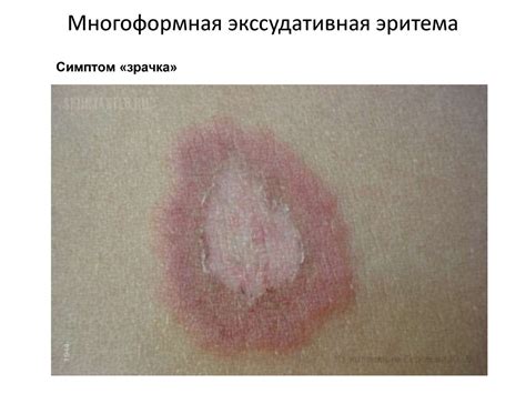 Вирусные заболевания кожи, герпесы, бородавки, остроконечные кондиломы ...