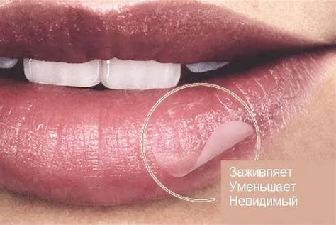 Пластырь от герпеса на губах - производители, как применять