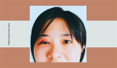 swollen eyelid prevention  effective treatments